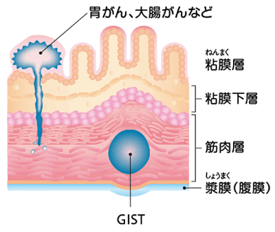 GISTのQ&A | グリベック®を服用されるGIST（消化管間質腫瘍）患者さん 